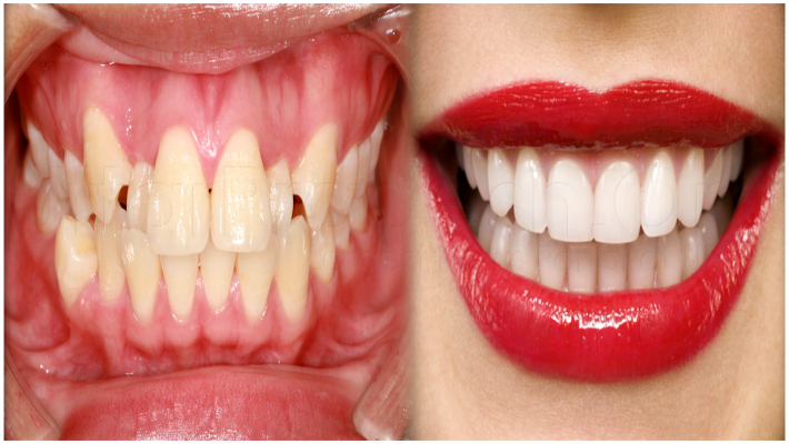 rubbish teeth
