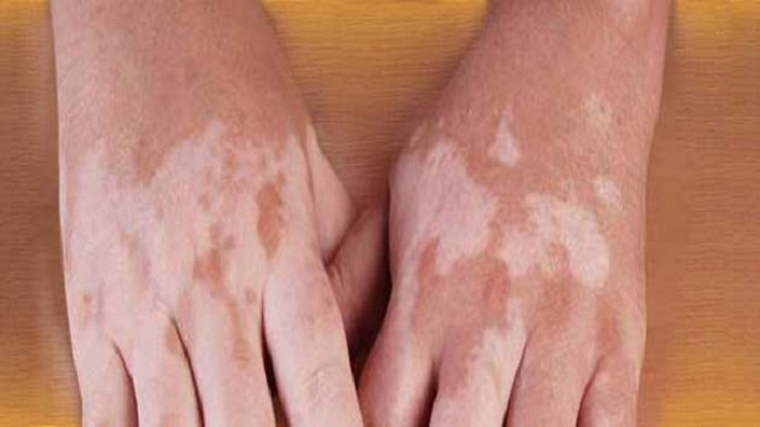 white patches on skin